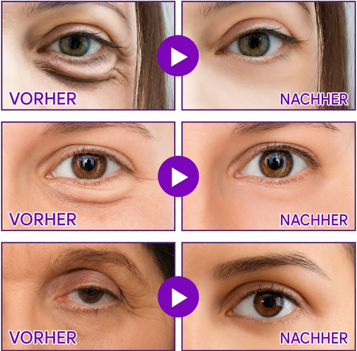 Mikronadel-Augenpads (30-TAGE-VORRAT)